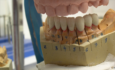 protesis dental combinada_19
