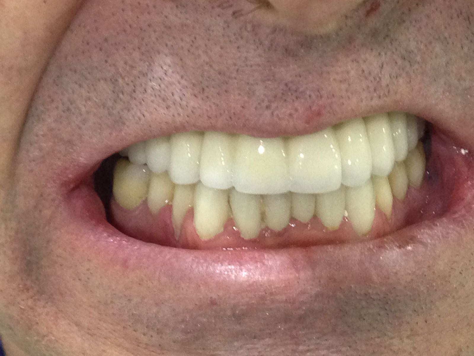 Prótesis Estética Dental. Implantes.